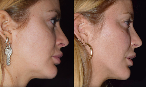 Cheek FIller Jaw & Contouring Toronto